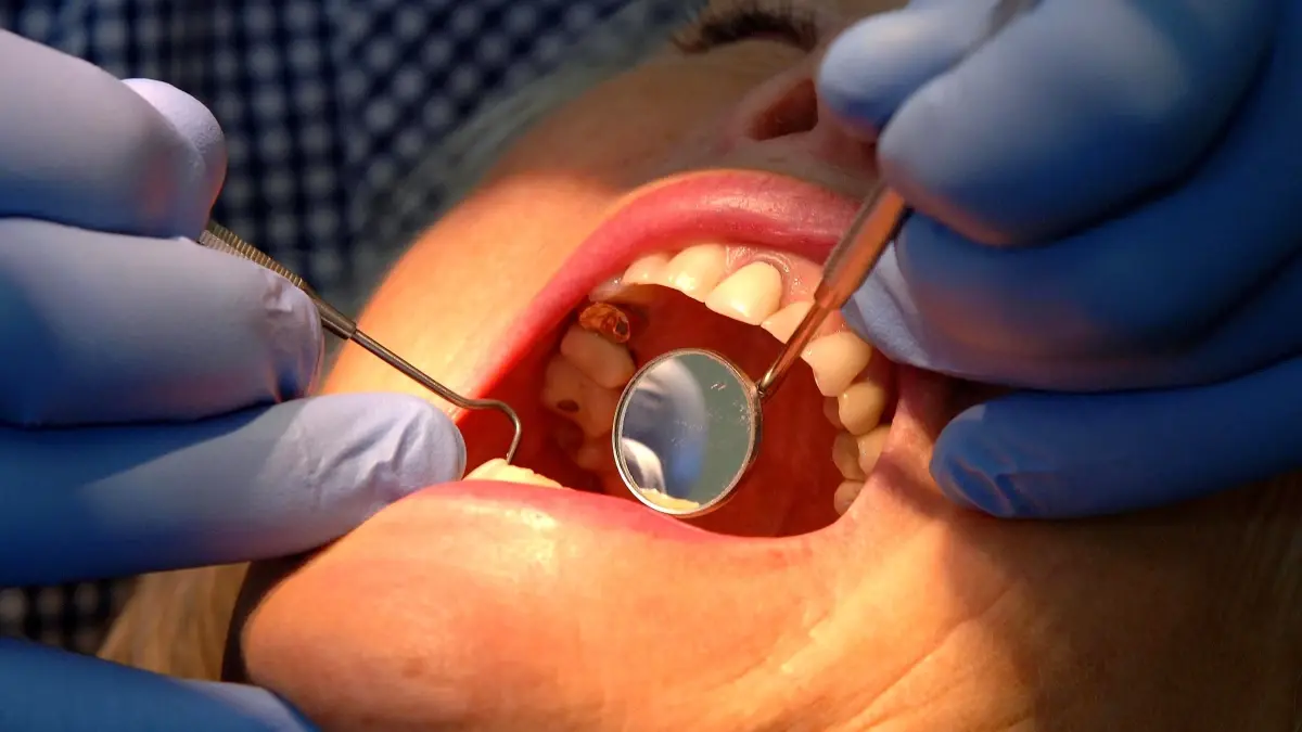 nottingham universitesinden dis minesini yenileyen yeni jel gelistirildi WEtKba5a.jpg